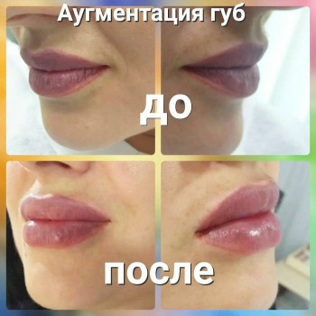 Збільшення губ, фото -  JULIA BEAUTY STUDIO
