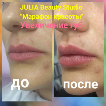 Збільшення губ, фото -  JULIA BEAUTY STUDIO
