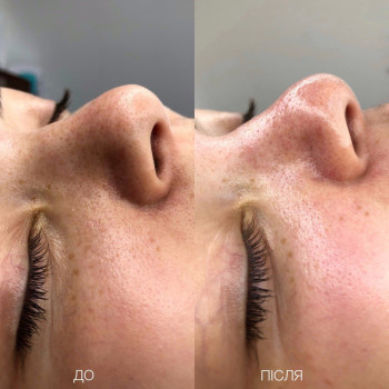 Комбинированная чистка лица. До/После