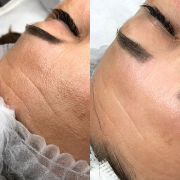 Карбокситерапия. Фото До/ После