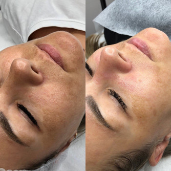 Карбокситерапия. Фото До/ После