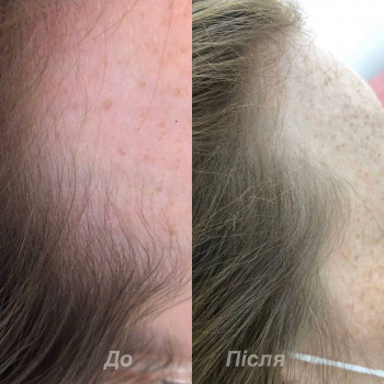 Курс мезотерапии для волос. Было сделано 5 процедур