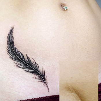 Перекриття шраму від апендициту