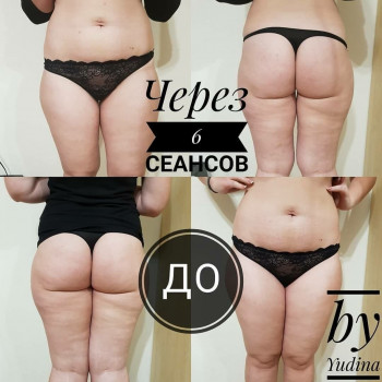 Антицелюлітна програма
                    Салон краси Мастерская Красоты "Юлии Юдиной" Київ