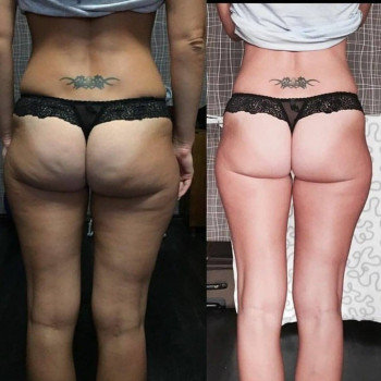 Антицелюлітна програма
                    Салон краси Мастерская Красоты "Юлии Юдиной" Київ