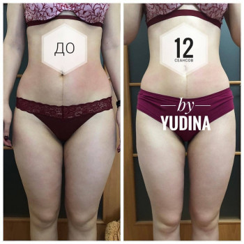 Антицелюлітна програма
                    Салон краси Мастерская Красоты "Юлии Юдиной" Київ