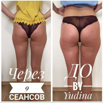 Антицелюлітна програма
                    Салон краси Мастерская Красоты "Юлии Юдиной" Київ