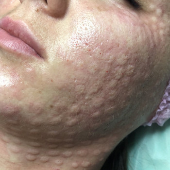 Биоревитализация
                    Врач-косметолог Алина Киев