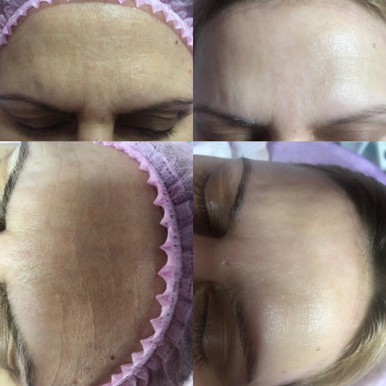 после процедуры, фото до и после