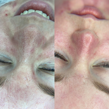 Вакуумный гидропилинг