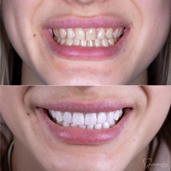 Керамічні вініри, фото - стоматолог Вепа Джумаев