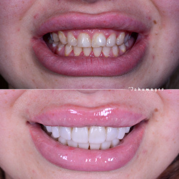 Керамічні вініри, фото - стоматолог Вепа Джумаев