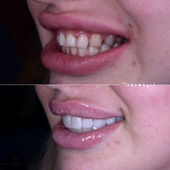 Керамічні вініри, фото - стоматолог Вепа Джумаев