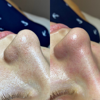 До/после. Комбинированная чистка лица.