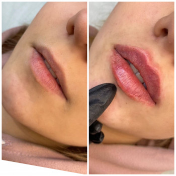 В губах 1 мл.филлера
Сразу после процедуры, присутствует от