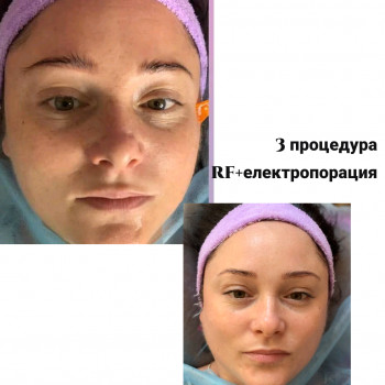 RF ліфтинг на апараті Zemits
                    Косметолог Лілія Винница