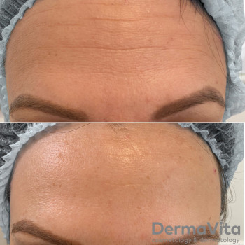 Корекція мімічних зморшок Dysport