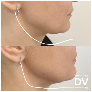 Корекція підборіддя