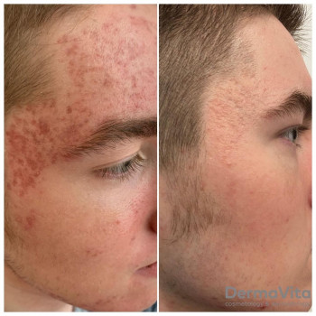 Лікування акне