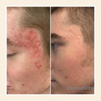 Лікування акне