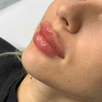 Збільшення губ філером