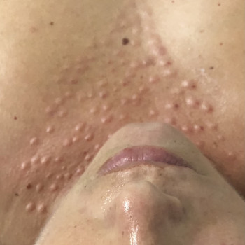 Омоложение зоны декольте! Увлажнение, лифтинг !