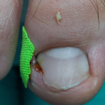 Врослий ніготь
    
 
 
 
 
 