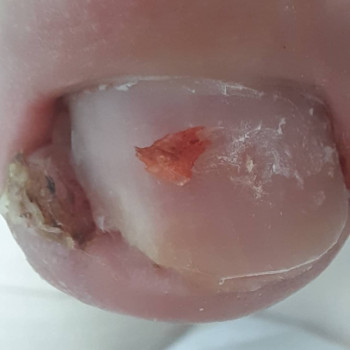 Врослий ніготь
    
 
 
 
 
 