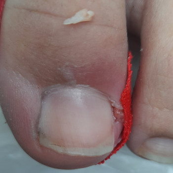 Врослий ніготь
    
 
 
 
 
 