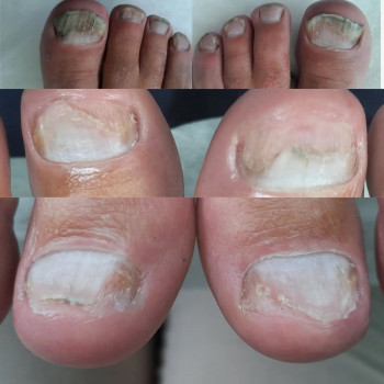 Грибоу нігтя
    
 
 
 
 
 