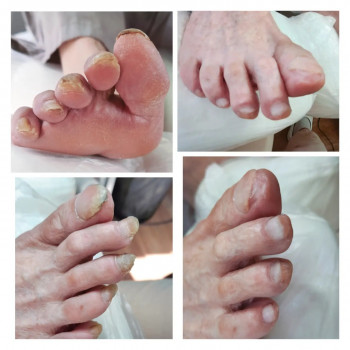 Моіжпальцевий мозоль
    
 
 
 
 
 
 