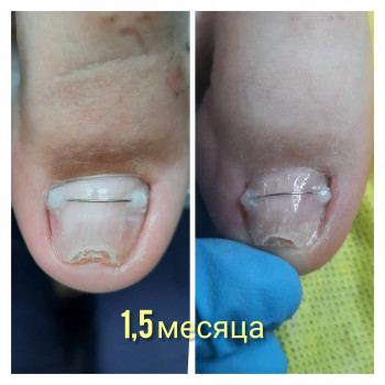 Скрученни ніготь
    
 
 
 
 
 