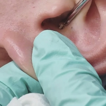 Чистка ушных раковин