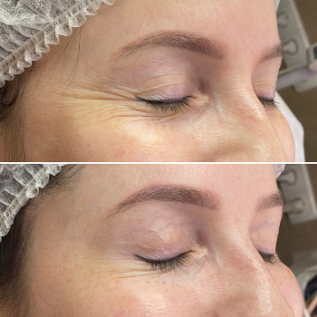 Ботокс глаз «гусиных лапок»