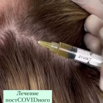 Плазмотерапия волосистой части головы. 
Запускаем рост новых