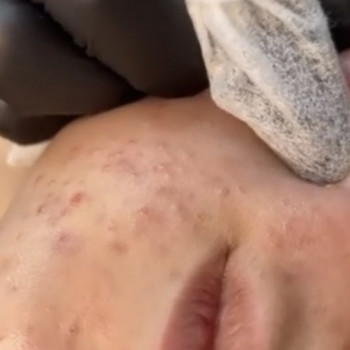 Комбинированная чистка лица
                    Дерматолог косметолог Анна Одеса