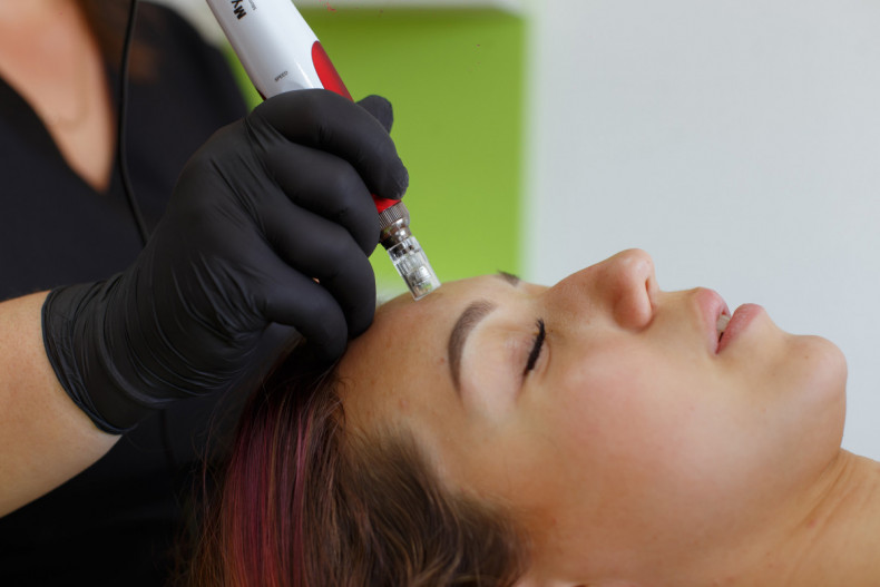 Фракційна мезотерапія, фото - Масажист Маргарита Капінос