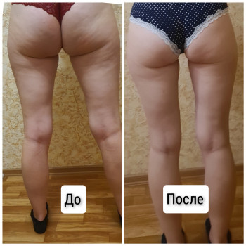 Антицеллюлитный массаж(ноги+ягодицы) курс из 15 сеансов