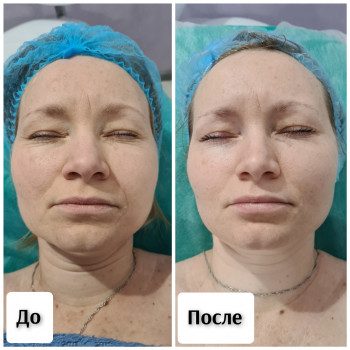 Классический массаж лица