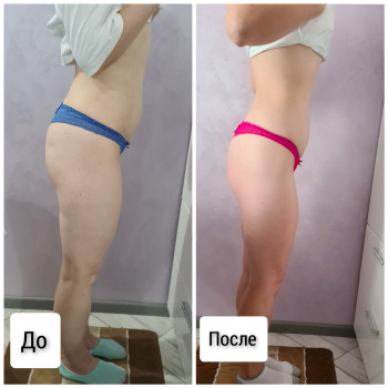 Антицеллюлитный массаж (живот, бока,ноги, Ягодицы)
