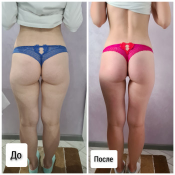 Антицеллюлитный массаж (живот, бока,ноги, ягодицы)