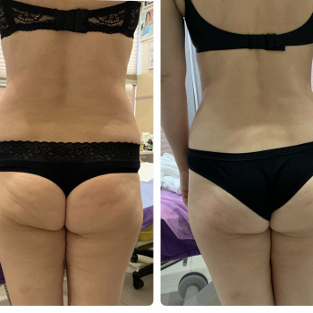 Результат 10 процедур