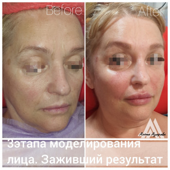 Контурная пластика скул
                    Косметолог Алена Харьков