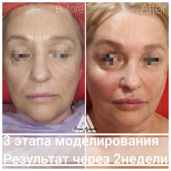 Контурная пластика скул
                    Косметолог Алена Харьков