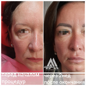 Контурная пластика скул
                    Косметолог Алена Харьков