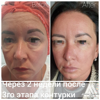 Контурная пластика скул
                    Косметолог Алена Харьков