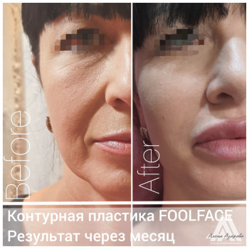 Контурная пластика скул
                    Косметолог Алена Харьков