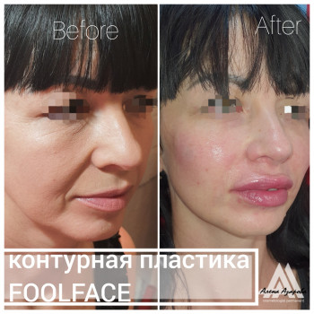 Контурная пластика скул
                    Косметолог Алена Харьков
