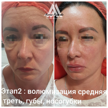 Контурная пластика скул
                    Косметолог Алена Харьков