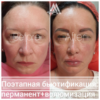 Контурная пластика скул
                    Косметолог Алена Харьков